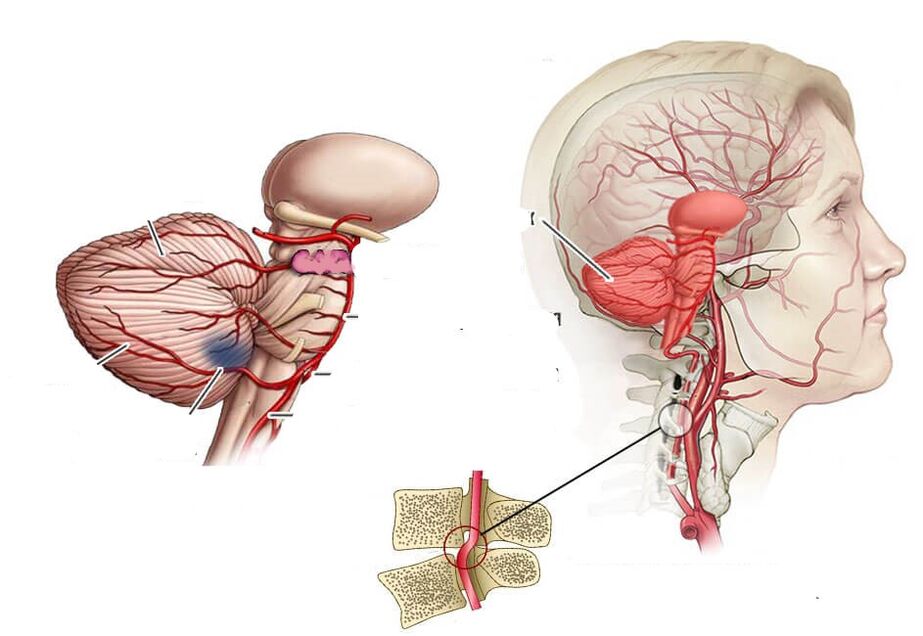 Cerebelar Ischemia